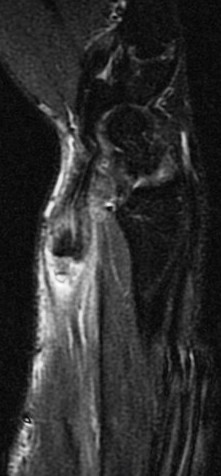 Figure 2 for case Flexor carpi radialis tendon laceration ( RID2388 )